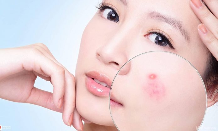 nguyen nhan mun trung ca thanh duoc